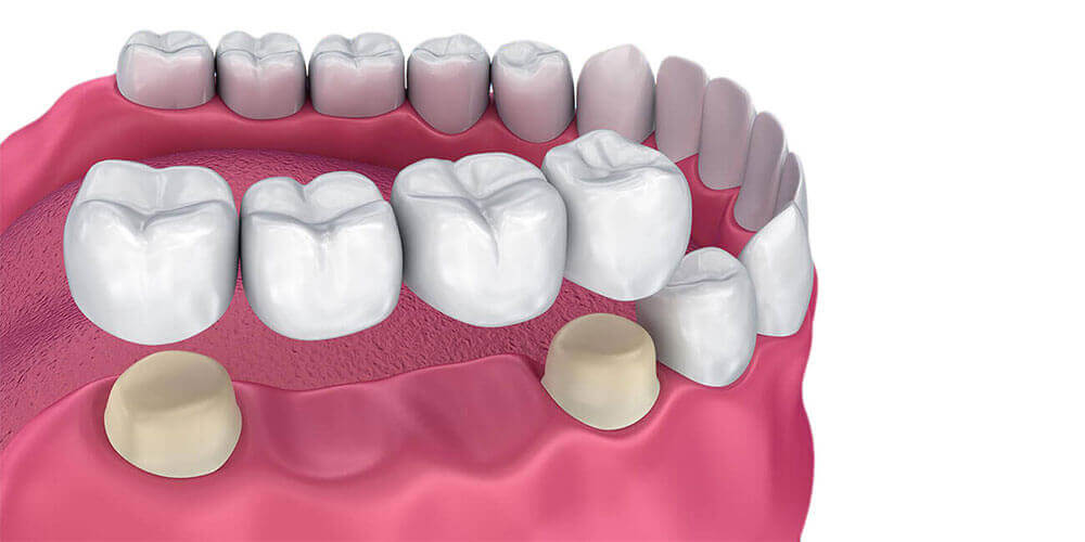 Dental Bridges Pasco