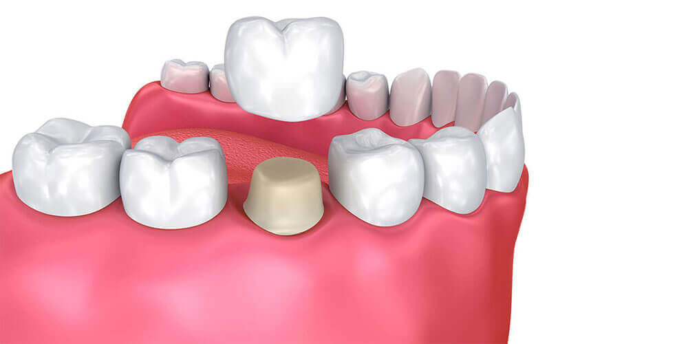 Dental Crowns Pasco