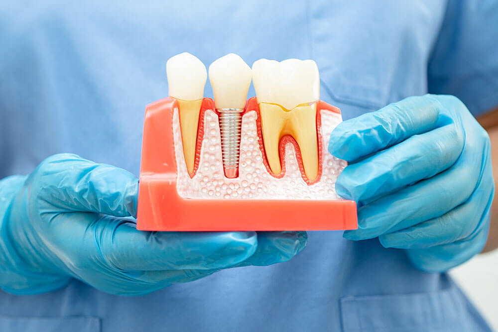 Dental Implants Pasco