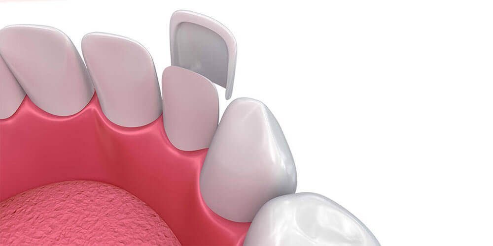 Dental Veneers Pasco